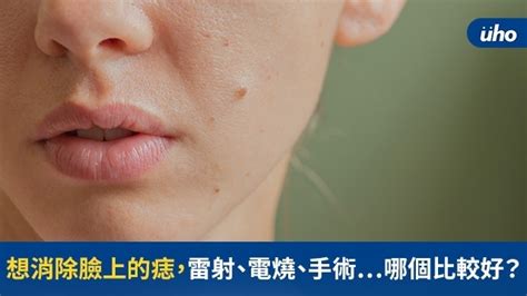 痣長在臉上|痣變大、痣多或長毛會變皮膚癌？認識痣的形成與原因